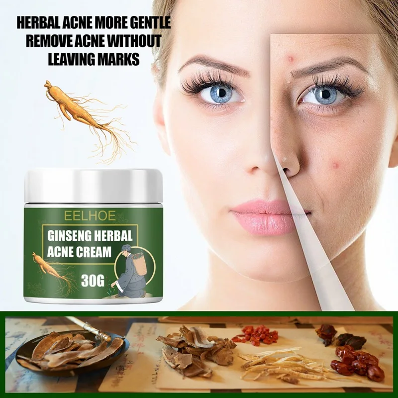 Herbal Ginseng Acne Cream Relieve Moisturizing Skin Care Blackhead Removal Facial | Красота и здоровье