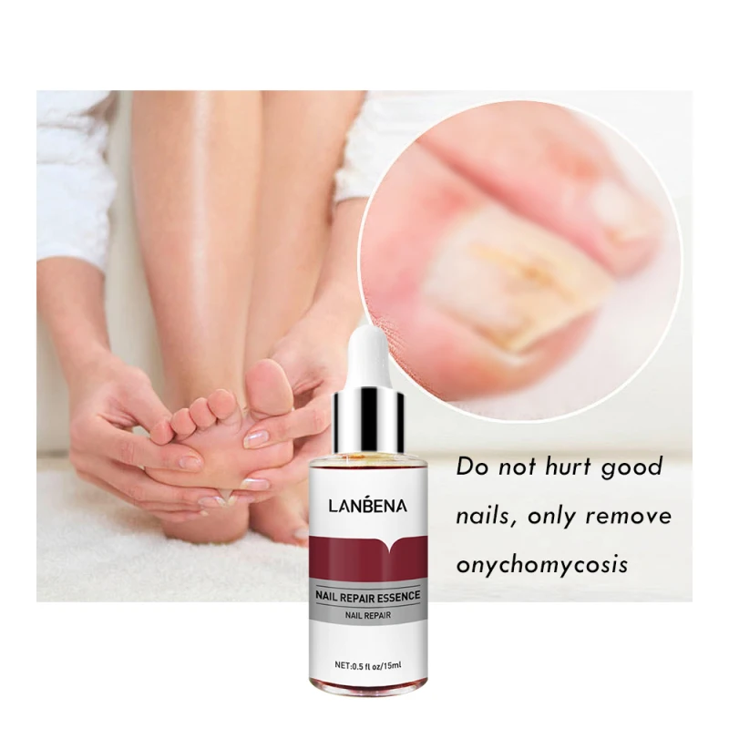 

LANBENA Fungal Nail Repair Essence Serum Anti Infection Paronychia Onychomycosis Treatment Care Foot Nail Fungus Removal Gel