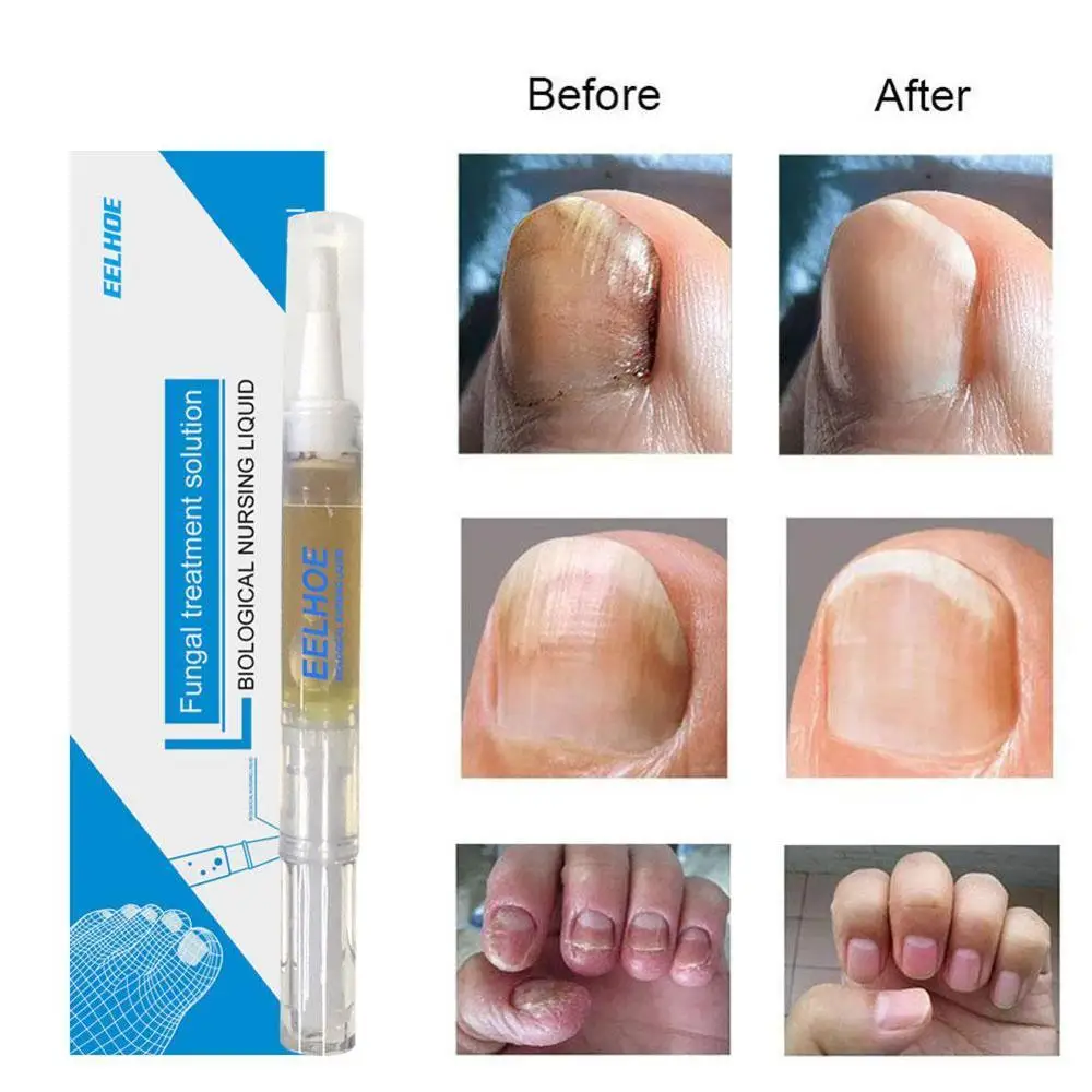 

1PC 3ML Fungal Nail Treatment Pen Onychomycosis Paronychia Herbal Medicinal Care Nail Anti Liquid Chinese Fungal Infection P2Y5