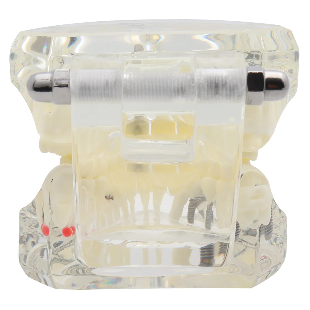 Зубная модель зубов имплантат и реставрация прозрачное исследование