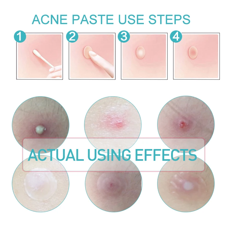 Патчи от акне Невидимые для удаления прыщей ухода за кожей 36 шт. = 1 пакет|Пластыри