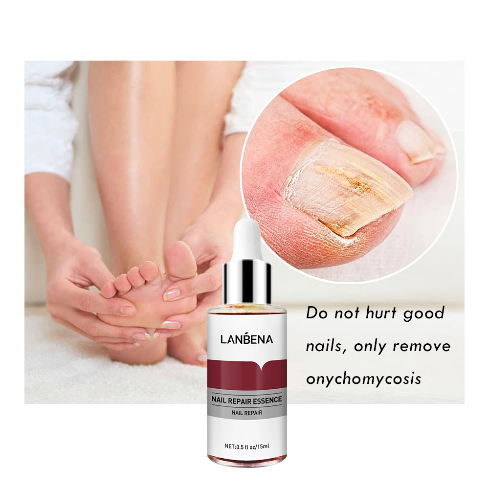 LANBENA Fungal Nail Treatment Feet Care Essence Removal Fungus Healthy Repair Serum Anti Infection Paronychia Onychomycosis