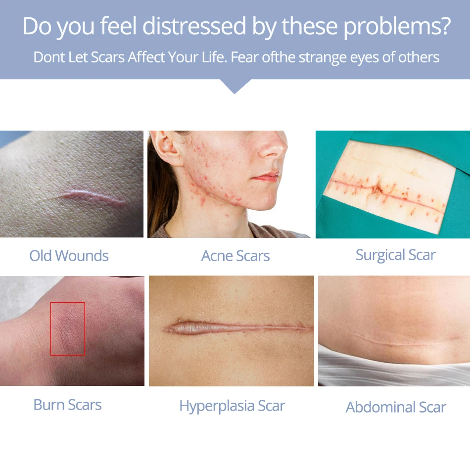 

"MSLAM Scar Removal Cream Acne Scars Gel Stretch Marks Acne Pigmentation Scar Repair Surgical Spots Care For Body Burn Correct