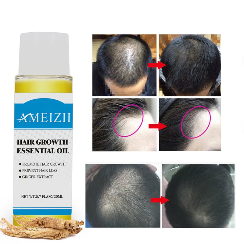 

Ginger plant extract fast-growing hair essential oil liquid care, anti-hair loss product 20ml, quickly restore thick hair!