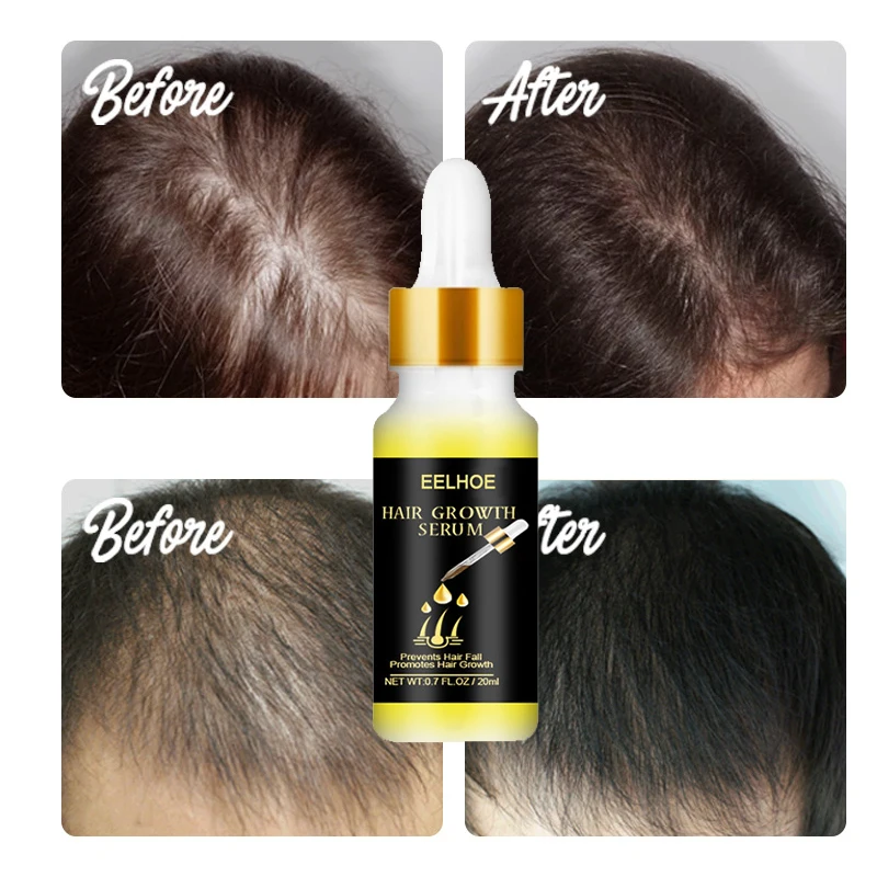 Имбирная Сыворотка для роста волос масло травяная быстрорастущая эссенция