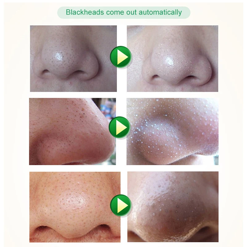 

Blackhead Exported Essence Effectively Soften The Horny Remove Blackheads for Skin Care SK88