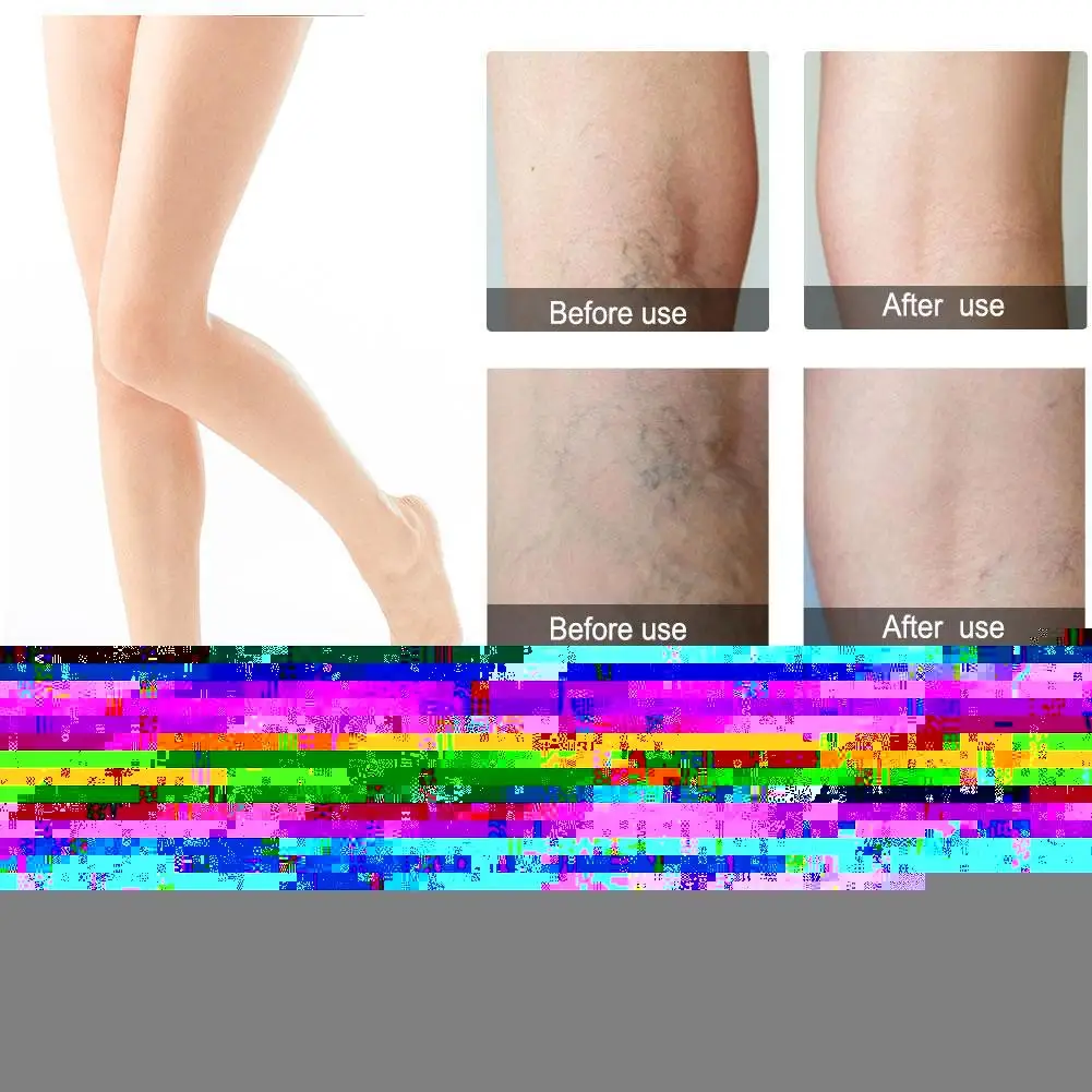 Варикозное расширение вен гель и лечение ручка эффективным снимают Природный