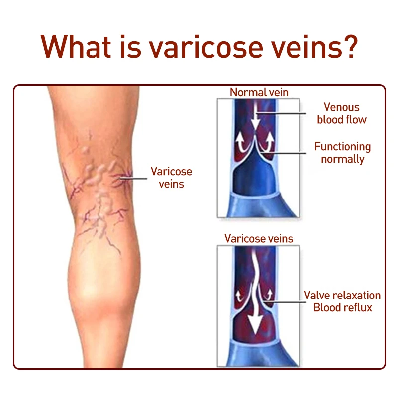 

Varicose Veins Treatment Medicine Patches Cream Ointment Vasculitis Phlebitis Spider Veins Pain Varicosity Angiitis Plaster