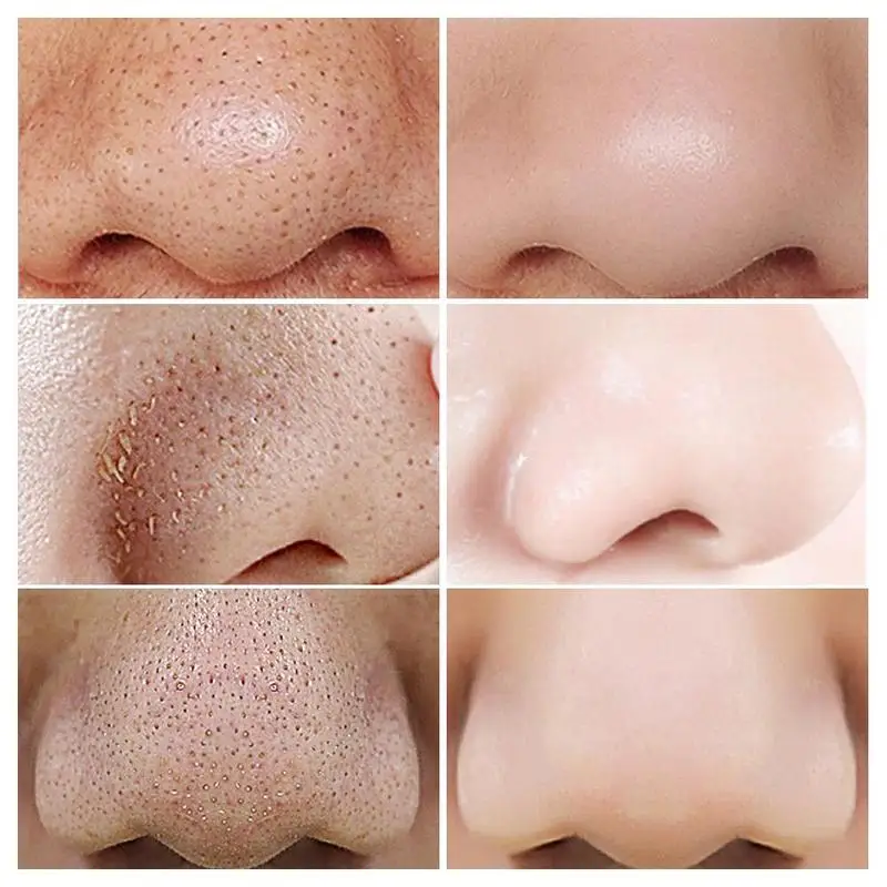 

1 Pcs Blackhead Acne Mask Acne Mask Green Tea Bamboo Pore Blackhead Nose Nose Remove Patch Shrink Charcoal Patch R5A9