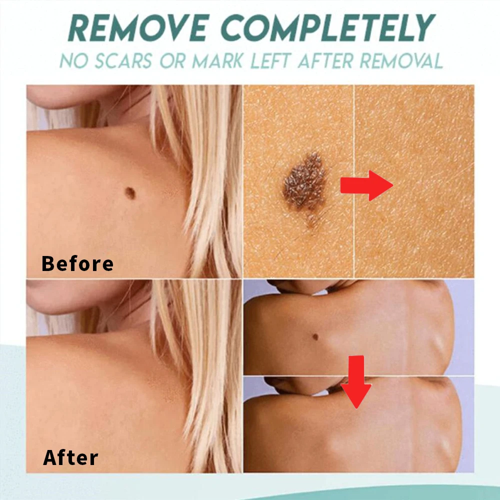 Патчи от акне натуральные поглощающие прыщи патчи медицинские Гидроколлоидные es