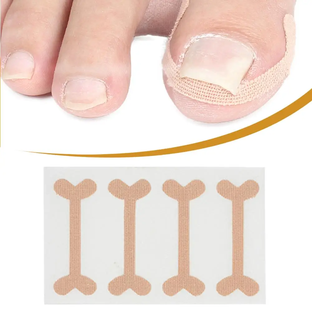 20 шт вросших ногтей Корректор наклейки лечение паронихией восстановление