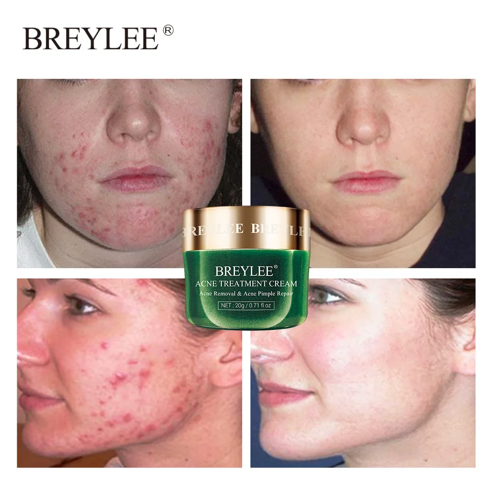 

BREYLEE Tea Tree Acne Treatment Face Cream Anti Acne Remove Pimple Spot Oil Control Shrink Pore Moisturizing Whitening Skin Care