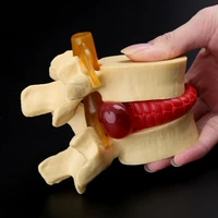 anatomical spine lumbar disc herniation anatomy medical teaching tool