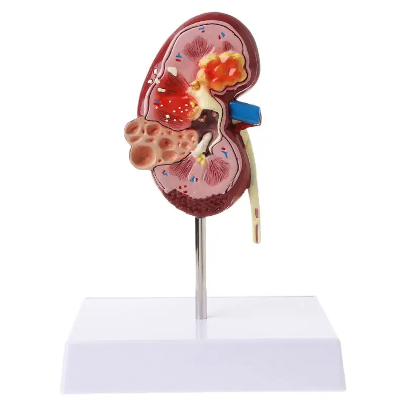 

2021 New Life Size Human Kidney Diseased Model Anatomical Anatomy Diseased Pathological Stone Organ Teaching Supplies