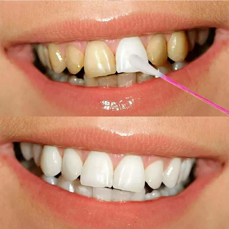 2018 Горячая естественная отбеливание зубов быстрый эффект для желтого зубного