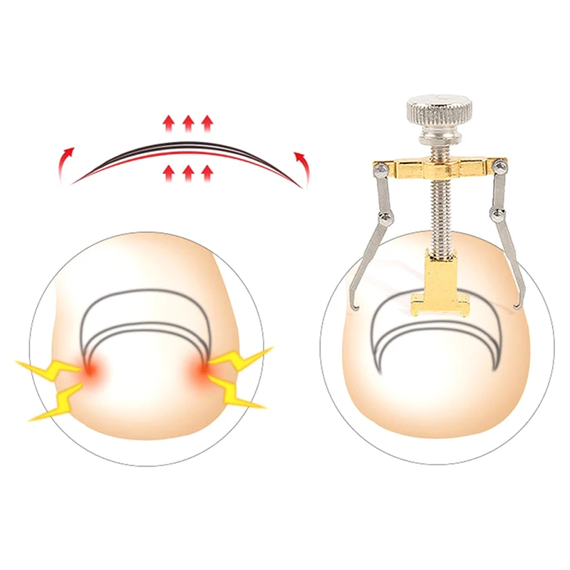 

Ingrown Toenail Correction Tool Set Nail Pedicure Elastic Patch Nail Correction Lifter Pusher Clasp Brace Bunion Correctors