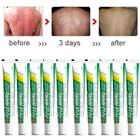 20 шт. Оригинальный FULEWANG кожи крем от псориаза дерматит экзематоидная мазь для лечения экземы 15 г с коробкой оптовая продажа Zudaifu