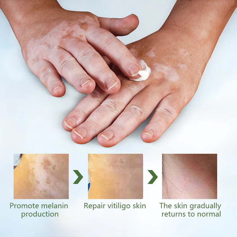 

1/3/5pcs Vitiligo White Spot Mycosis Leukoplakia Treament Cream Antibacterial Cream Psoriasis Localized Vitiligo Ointment