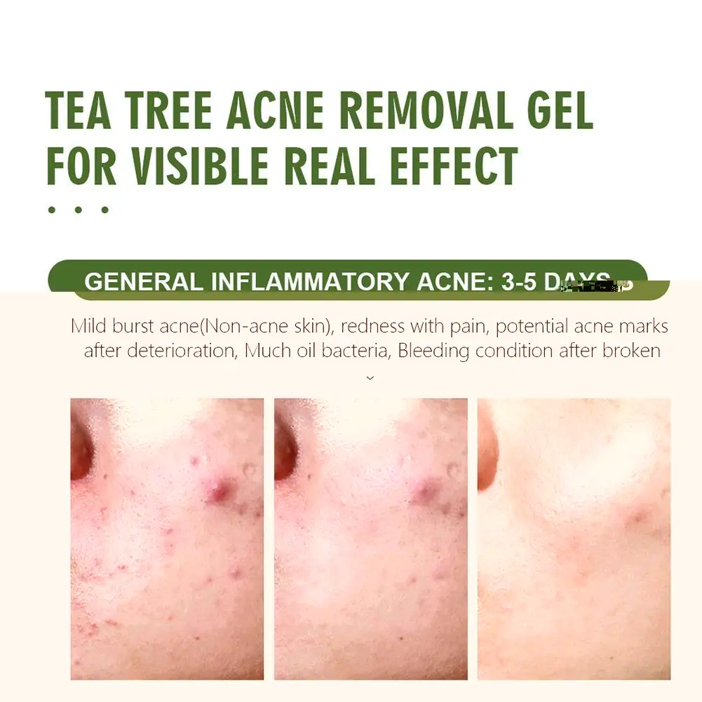 

25g VIBRANT GLAMOUR Tea Tree Acne Gel Moisturizing Acne Skin Remove Anti-Inflammatory Care Pores Anti Anti-Aging Shrink E0L5