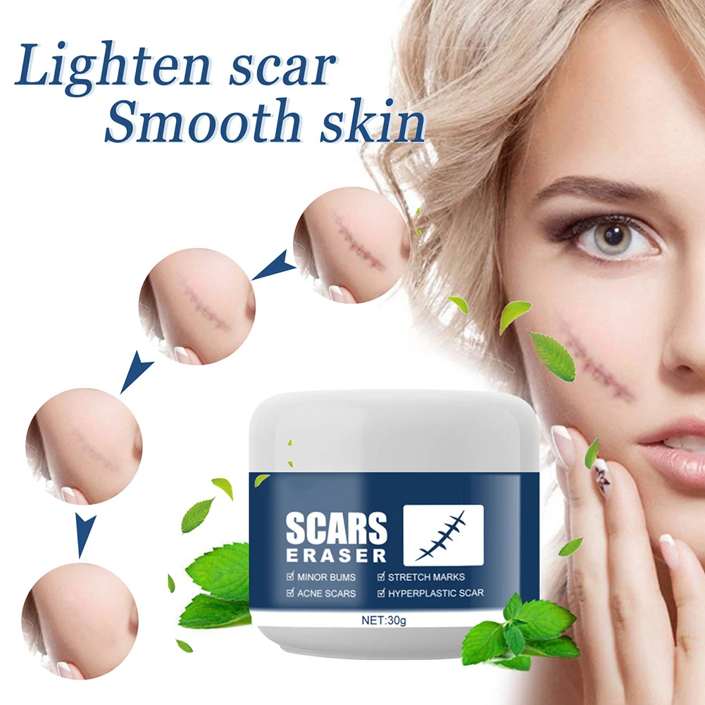 

Scar Acne Pimple Treatment Cream Scar Removal Cream Stretch Marks Remover Cream For All Skin Types