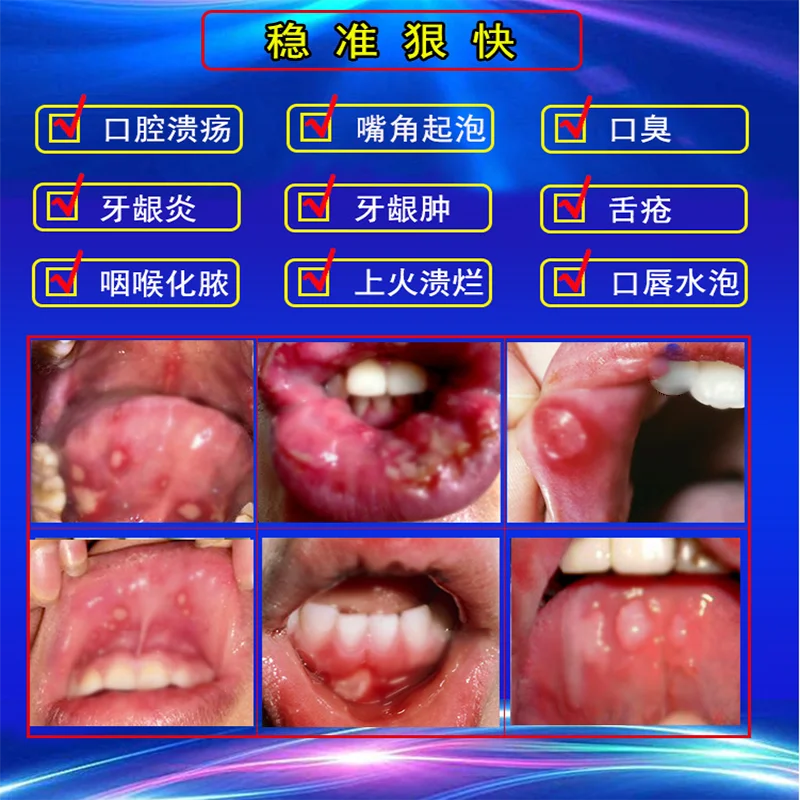 

Watermelon cream oral ulcer spray herbal extract oral care pharyngeal dry and itchy breath fresh and sore gum spray