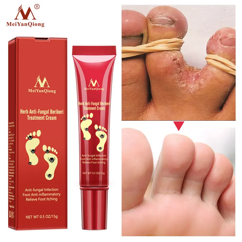 

Herbal Effective Foot Cream Anti Fungal Infection Treatment Onychomycosis Paronychia Toe Fungus Repair Dry Crack Feet Gel Care