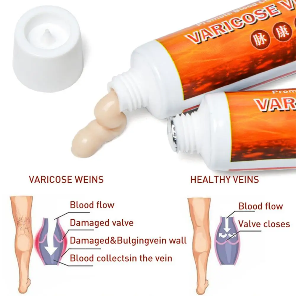 20g Varicose Veins Treatment Cream Herbal Vasculitis Phlebitis Pain Relief Angiitis Inflammation Rotten Legs Ointment Foot Care | Красота и