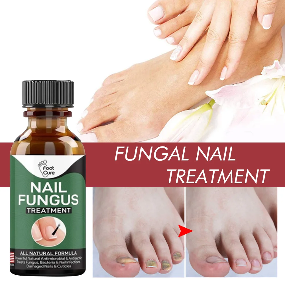 

Fast Nail Fungal Treatments Nail Repair Essences Serum Care Treatments Foot Nail Fungus Removal Gel Paronychia Onychomycosis