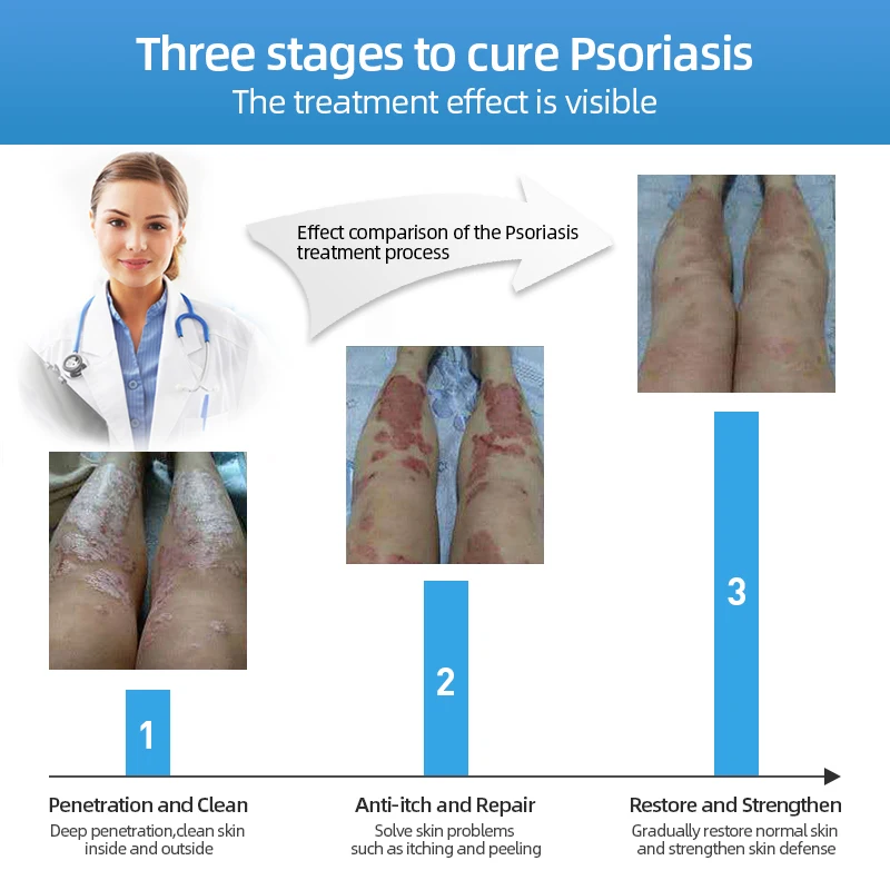 Натуральный травяной медицины псориаз мазь антибактериальные дерматит зуда для