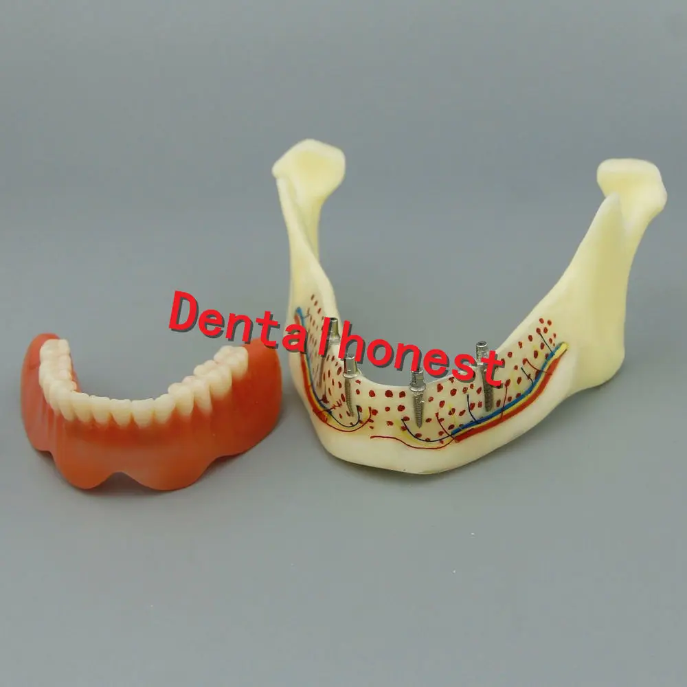 1 шт. Mandible имплантант зубов Модель для стоматологического обучения стоматолога