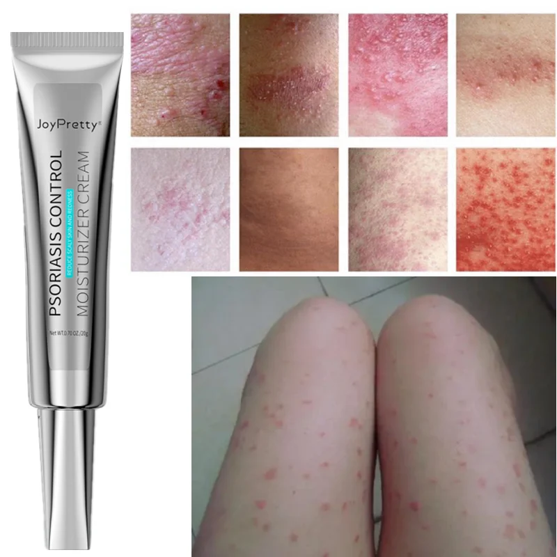 

Skin Ringworm King Ointment To Treat Skin Itching and Antipruritic Ointment To Remove Psoriasis Spots Fresh Ointment