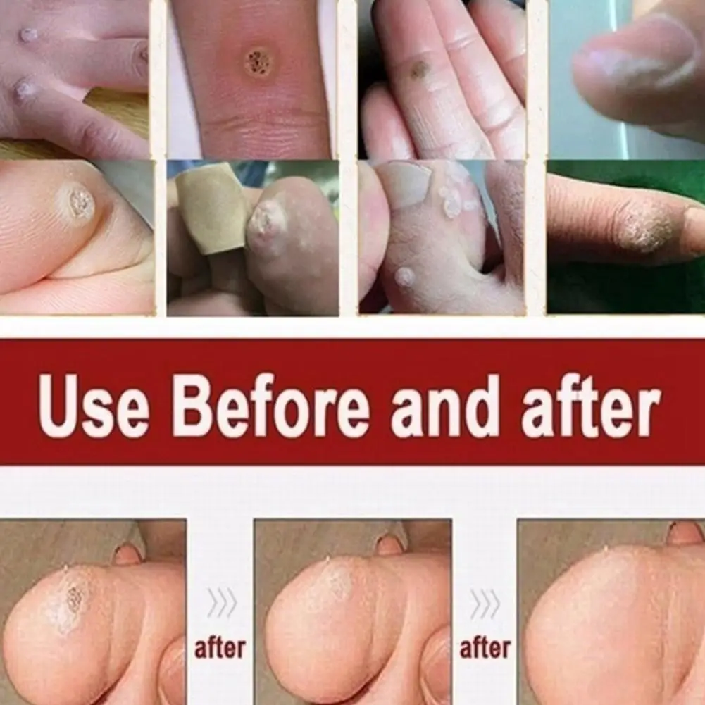 

1Pcs Mole Removing Cream Skin Tag Residue Treatment Care Face Healthy Wart Spot Remover Repair Dark Care Makeup Skin Cream Y8P9