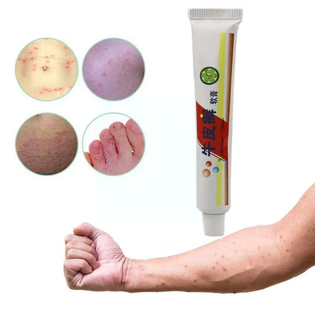 

New 2020 Psoriasis Ointment Powerful Professional Chinese Eczma Cream Ointment Ointment Original From Psoriasi Cure Psorias J1Y8