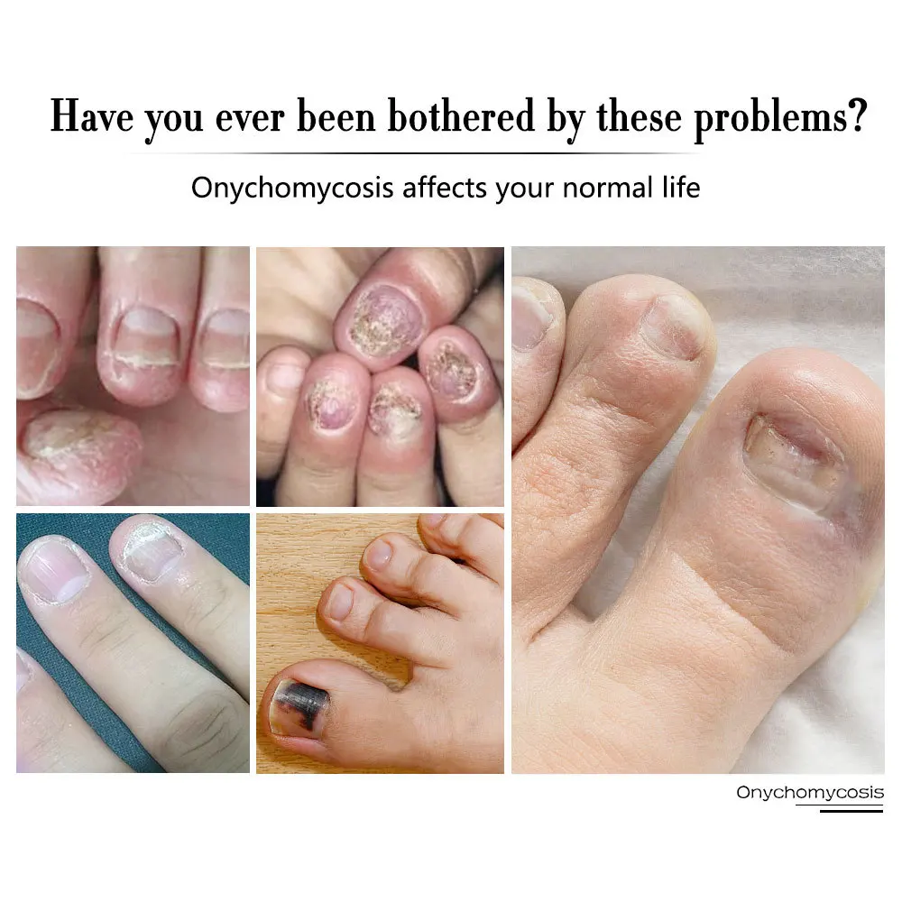 Ibcccndc Nail Care Solution Pen Go Gray Biofilm a Polish Remove Pencil | Красота и здоровье