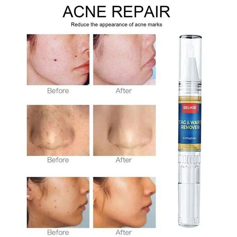 

Skin beauty mole removal pen Repair No Trace Beauty Liquid Skin Treatment Papilloma Of Removal Warts Mole Pen