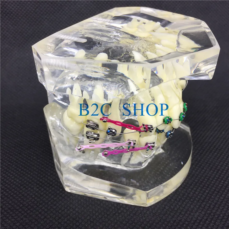 Стоматологическая Ортодонтическая модель с красочными кронштейнами для