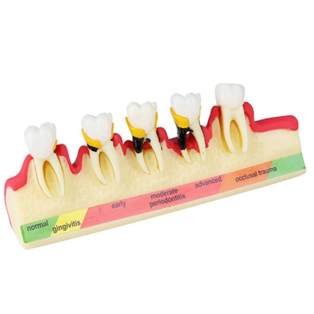 Oral Teeth Model Periodontal Disease Model /Dental disease tooth model M4010/Periodontal disease teaching model
