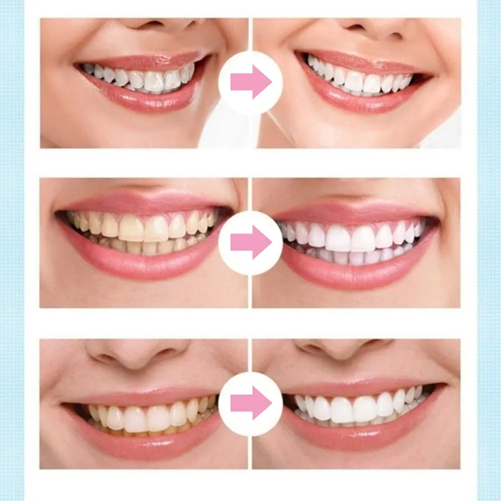 

Natural Teeth Whitening Gel Pen Oral Care Remove Stains Tooth Cleaning Whitener Tools Whitener Oral Hygiene Care Teeth Whitener