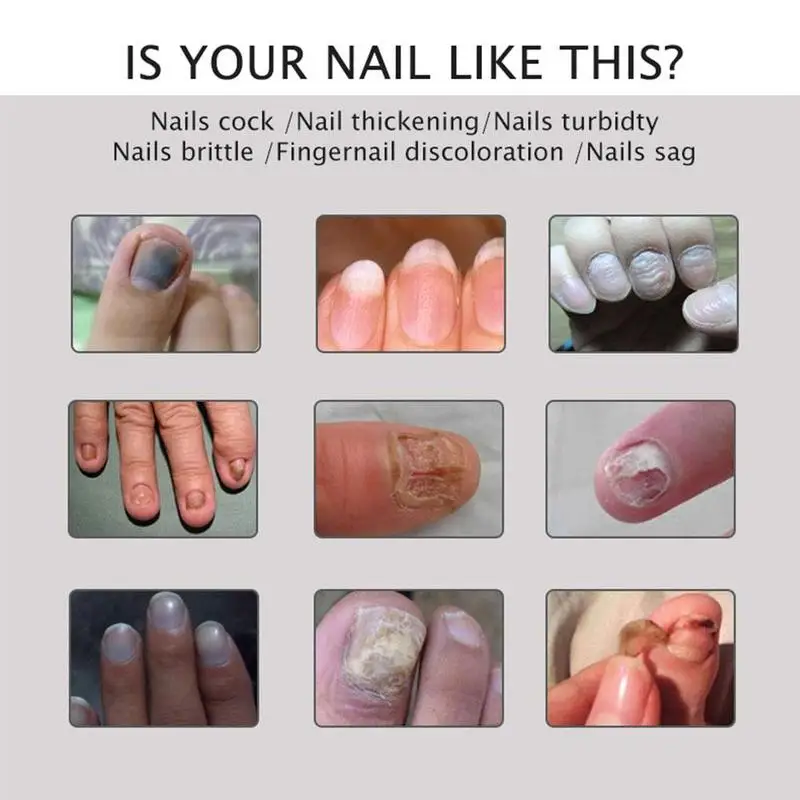 20g Nail Repair Cream Treatment Serum Nail Fungus Removal Nail Cream Gel Infection Anti Treatment Fungal J4V4