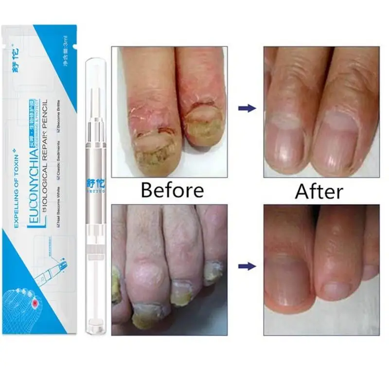 Лечение грибковым грибком ручка для ногтей онихомикоз паронихия травяное