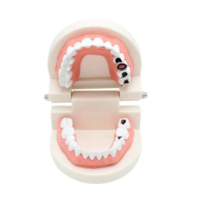Tooth Decay model Стоматологическая Ортодонтическая модель лечения с Орто-металлическим керамическим кронштейном АРКА Проволока Buccal труба Лигатура Галстуки стоматологические инструменты модель зубов - Цвет: Tooth Decay model