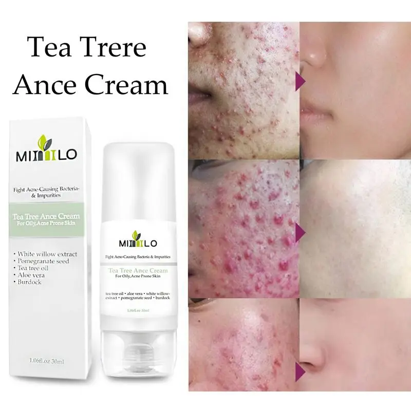 

Effective Acne Removal Cream Anti-Acne Repair Fade Acne Spots Oil Control Whitening Moisturizing Face Tea Tree Oil Skin Care