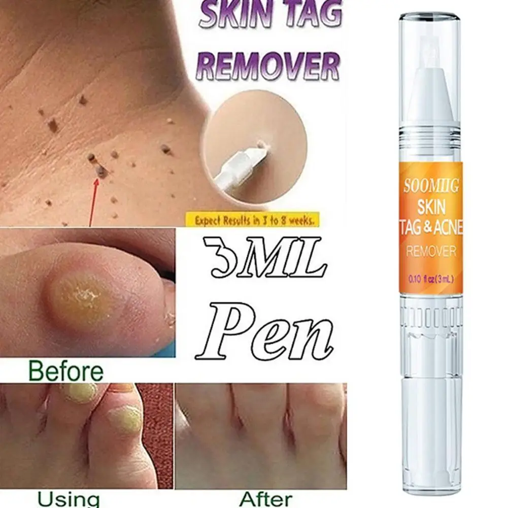 

3ml Tags & Moles Remover Liquid Wart Removal Pen Genital Removal Treatment Wart Removal Liquid Wart Pen Skin Wart Beauty V8D8