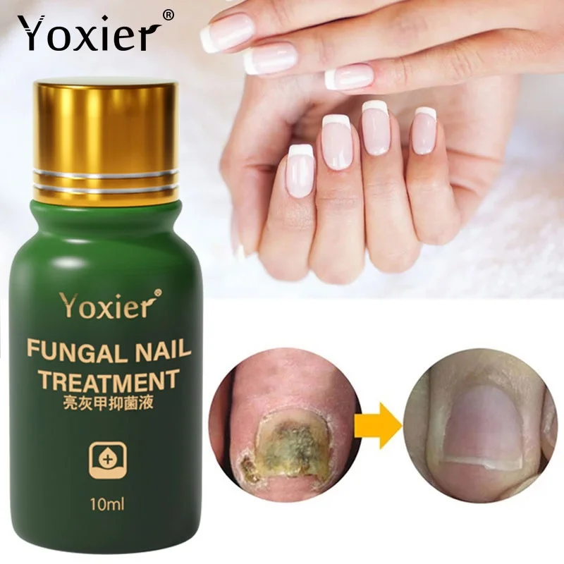 

Yoxier Fungal Nail Treatment Feet Care Serum Antibacterial Herbal Formula Repair Anti Infection 10ml