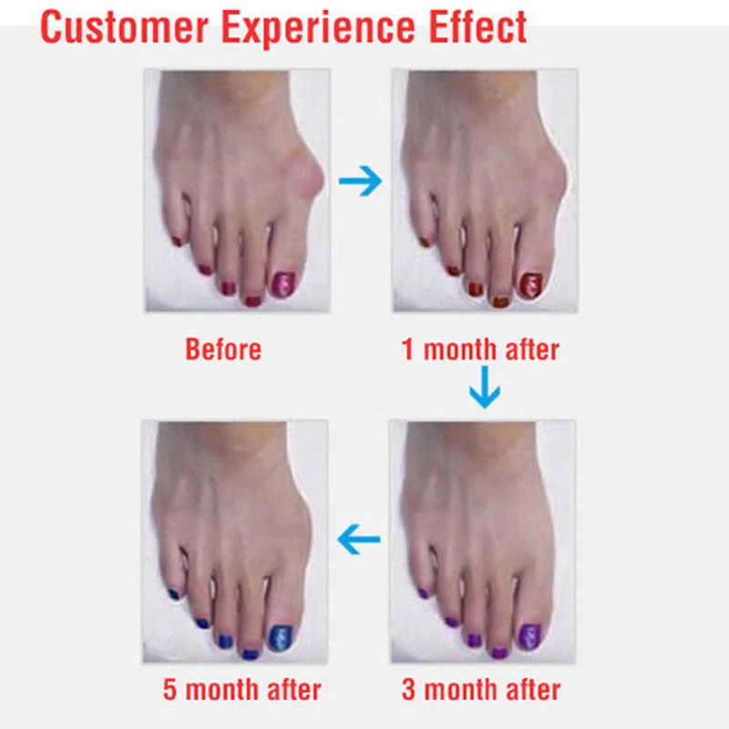 

35Pair Silicone Gel Separateur Orteil Toe Separator Finger Feet Care Pedicure Tools Bunion Guard Foot Hallux Valgus Correction