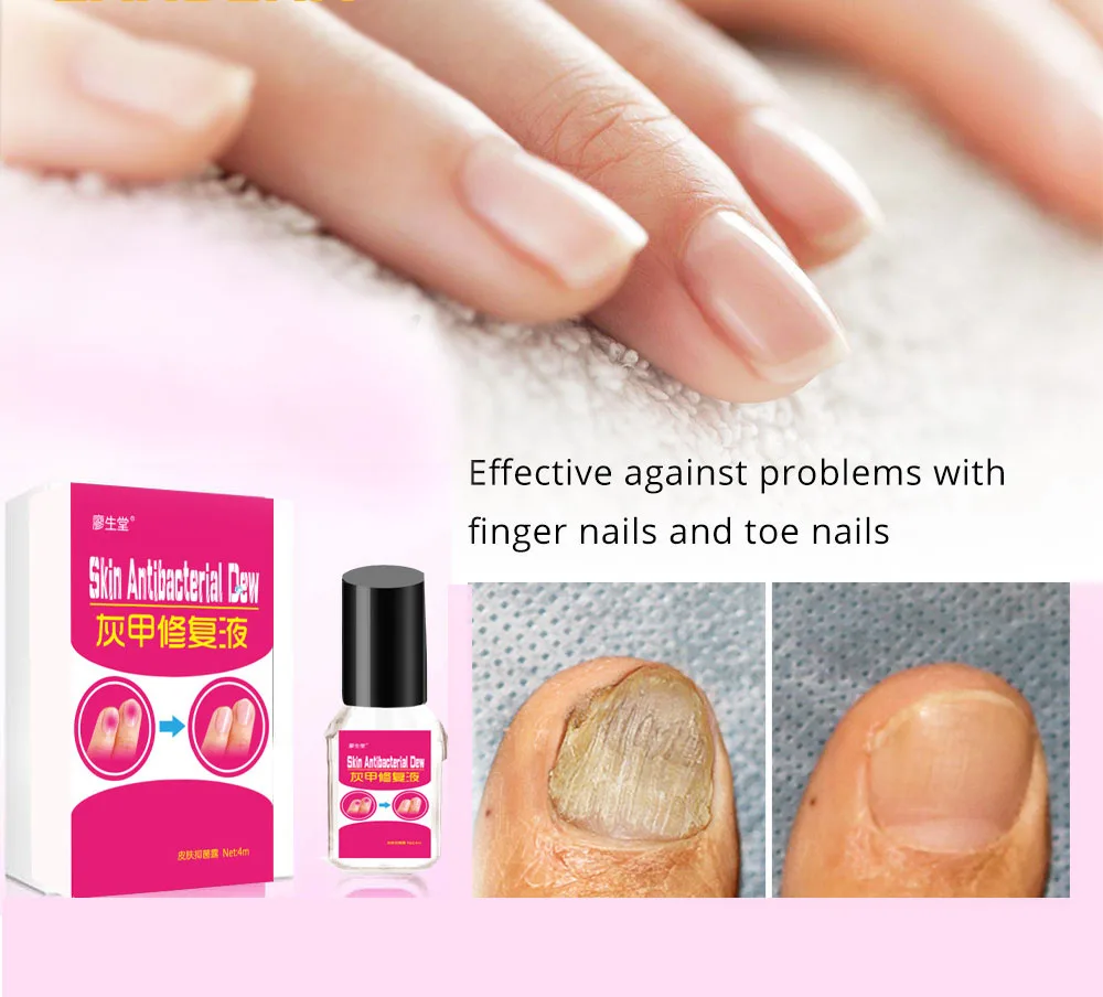 

Экстракт для лечения грибка ногтей Отбеливание ногтей и ног, Традиционная китайская медицина, средство для удаления грибка ногтей с эфирны...