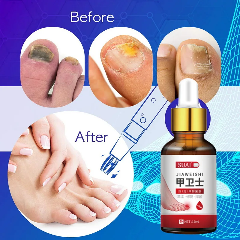 

Nail Fungal Treatment Feet Care Essence Nail Foot Whitening Toe Nail Fungus Removal Gel Anti Infection Paronychia Onychomycosis