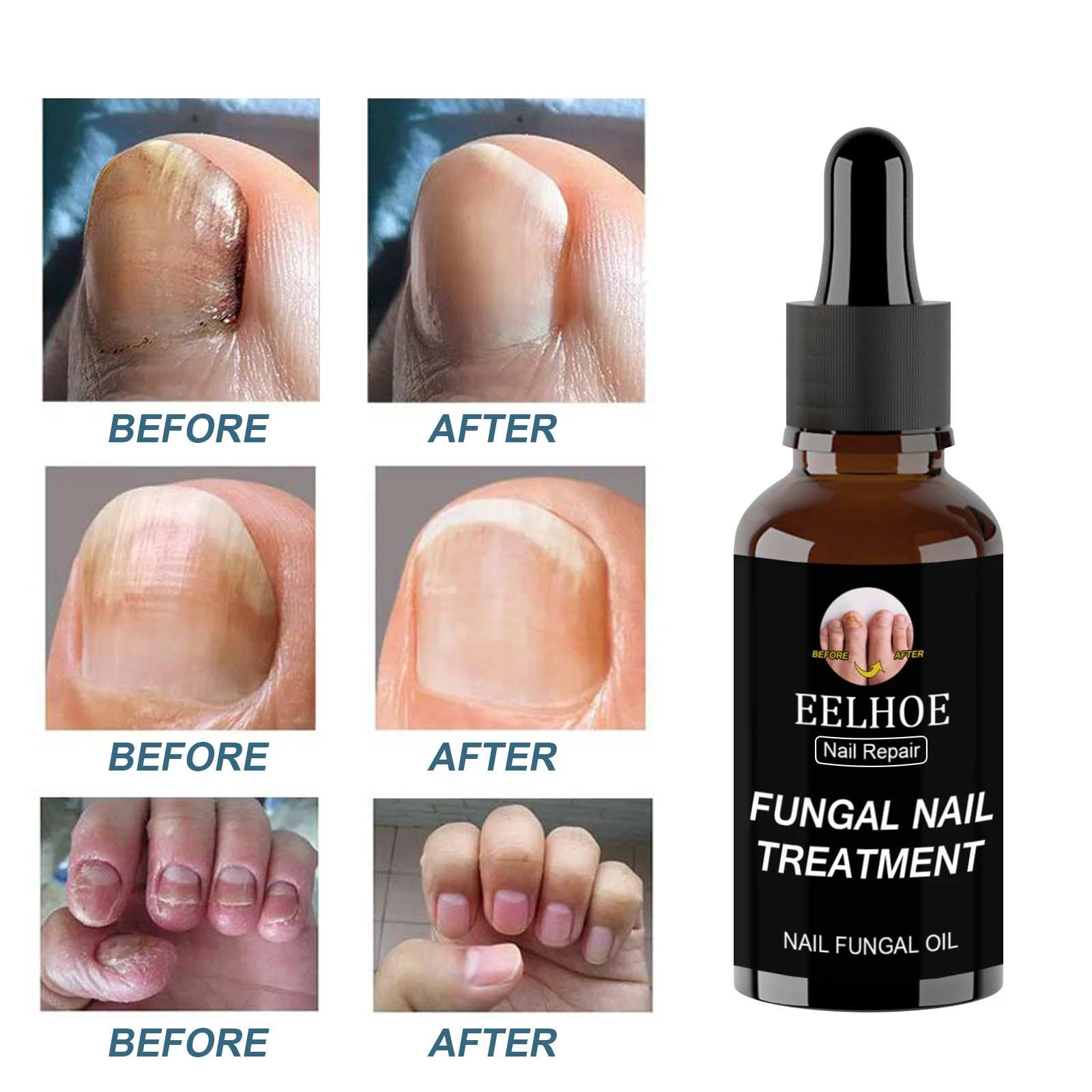 

Fungal Nail Care Essential Oil Fungus Removal Hand And Foot Care Serum Onychomycosis Repair Fluid Anti-Fungal Nail Gel Oil