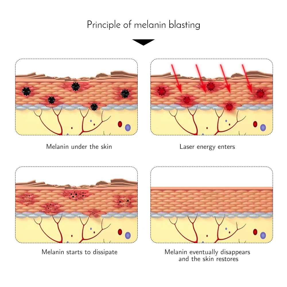 Пикосекундных лазерная ручка синий/красный светильник терапии пигмент тату шрам