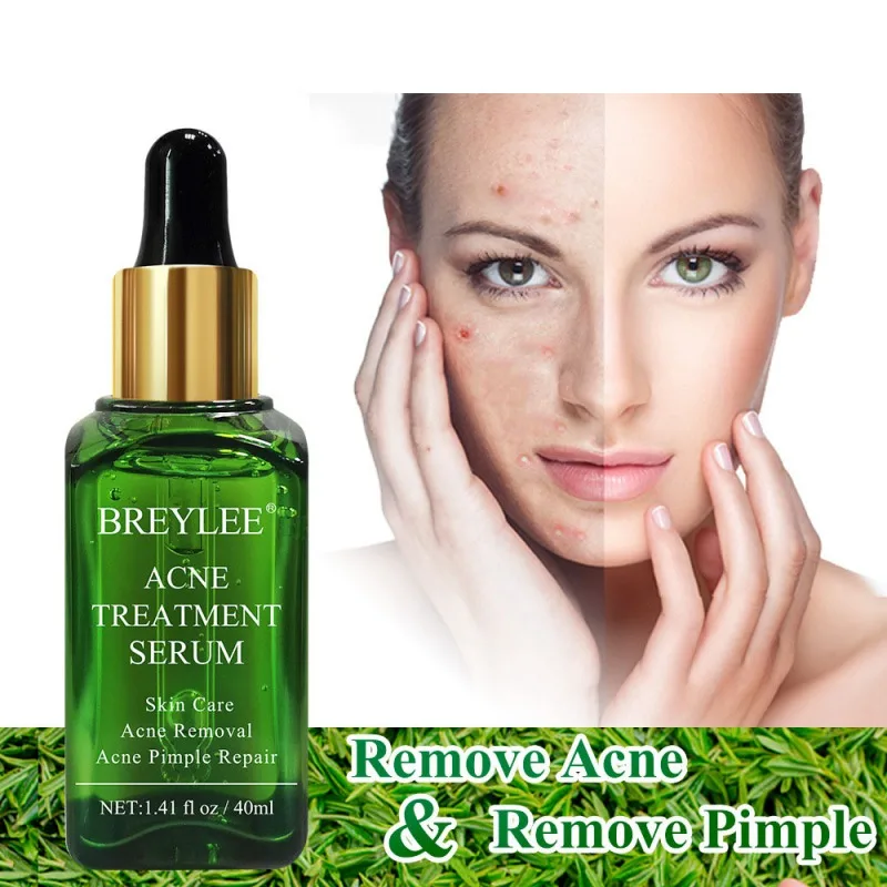 Акне лечебная сыворотка экстракт для лица анти Удаление Шрама от акне крем уход